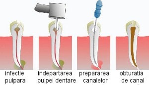tratament endodontic